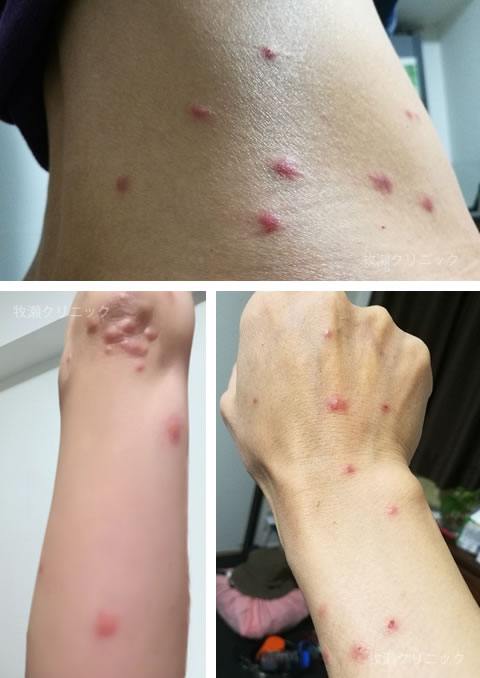 結節性痒疹皮膚疾患