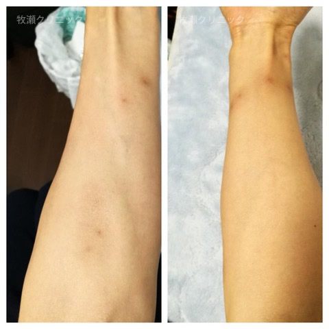 両方の手に結節性痒疹