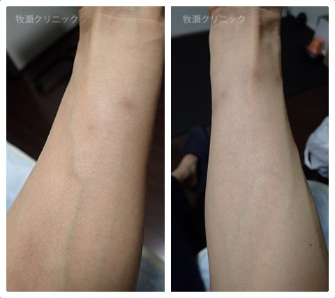 結節性痒疹治療の20日後