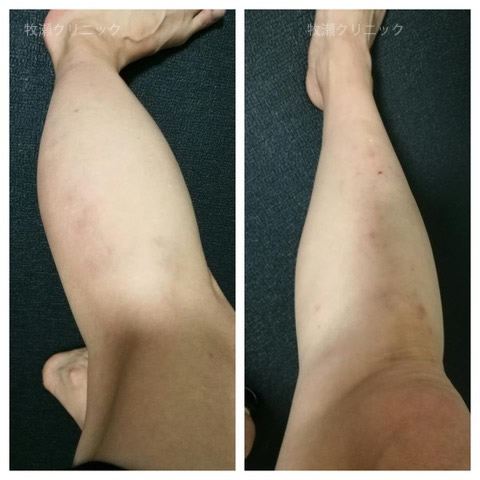 足の結節性痒疹が治癒